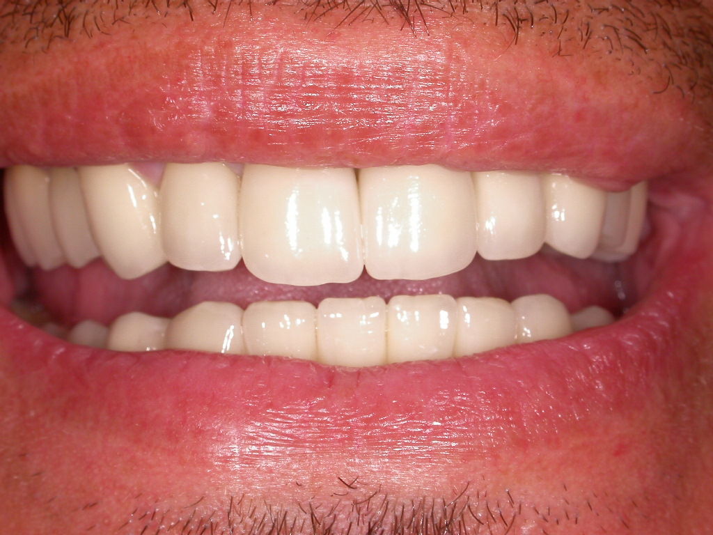 Korrektur in nur 2 Langzeitterminen